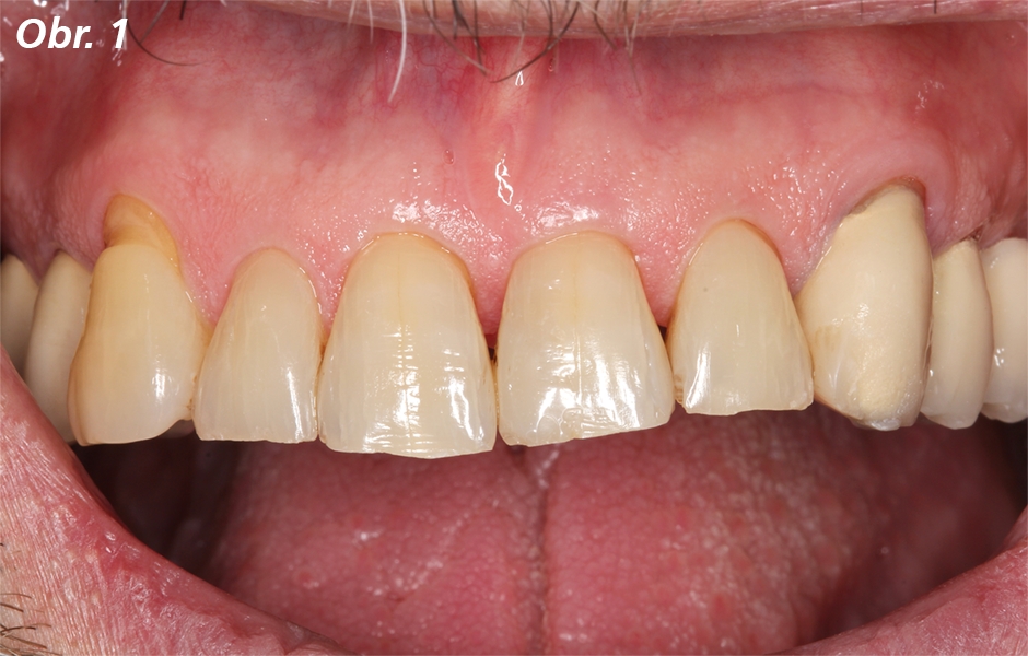 Počáteční situace vykazuje metalokeramickou náhradu s meziálním kohezním odlomením keramiky na zubu 23