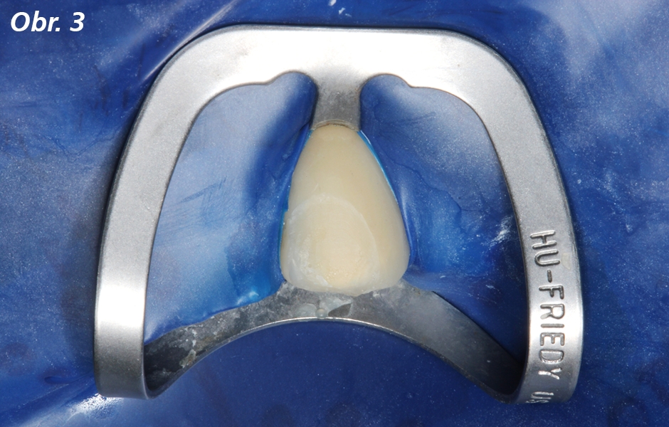 Příprava odlomeného keramického povrchu na nanesení GLUMA Bond Universal: Povrch se rozšíří zhruba 1 mm nad okraje lomu pomocí jemného diamantu a zdrsní se karbid křemičitým kaménkem, opláchne se a osuší