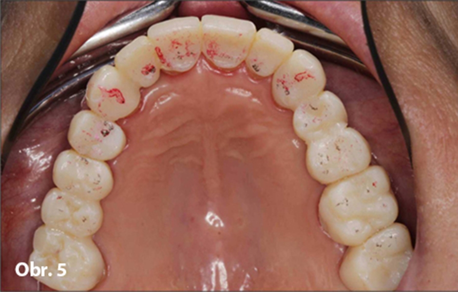 Obr. 5: Equilibrovaný chrup bez interferencí „in vivo” na provizoriích z mock-upu