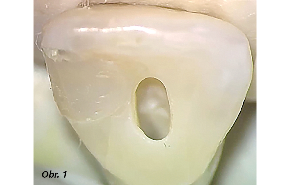  Příprava vstupů do kořenových kanálků – předpoklad úspěšné endodoncie