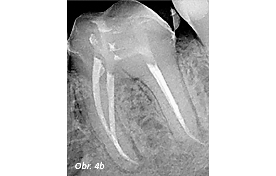  Příprava vstupů do kořenových kanálků – předpoklad úspěšné endodoncie