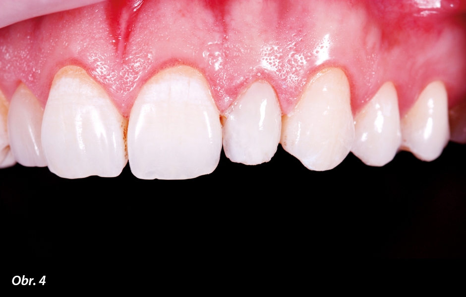 Zub je kompletně překryt vrstvou IPS Empress® Direct A2 Dentin