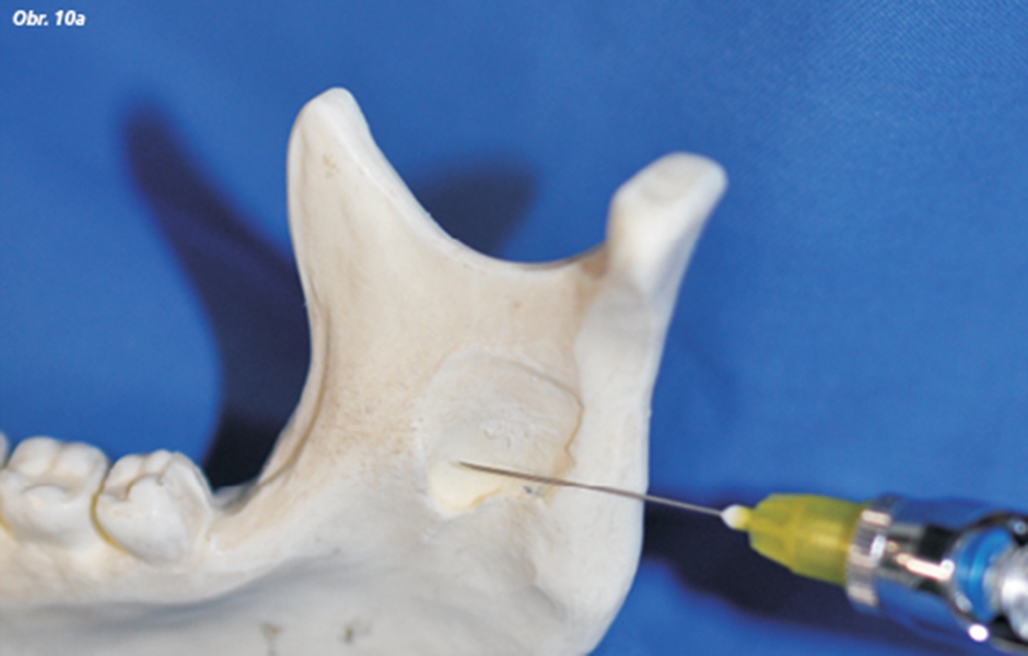 Spôsoby anestézie nervus alveolaris inferior podľa Peckerta (A) a Sichera (B)