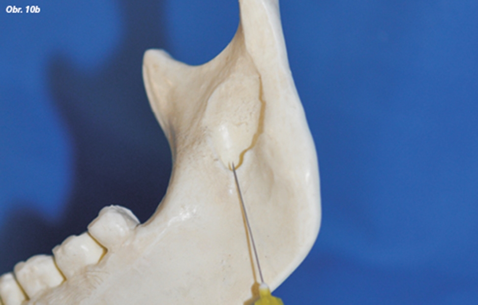 Spôsoby anestézie nervus alveolaris inferior podľa Peckerta (A) a Sichera (B)