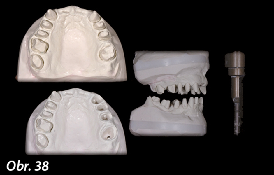 Protetický design, estetika, 3D gnatologie – 2. část