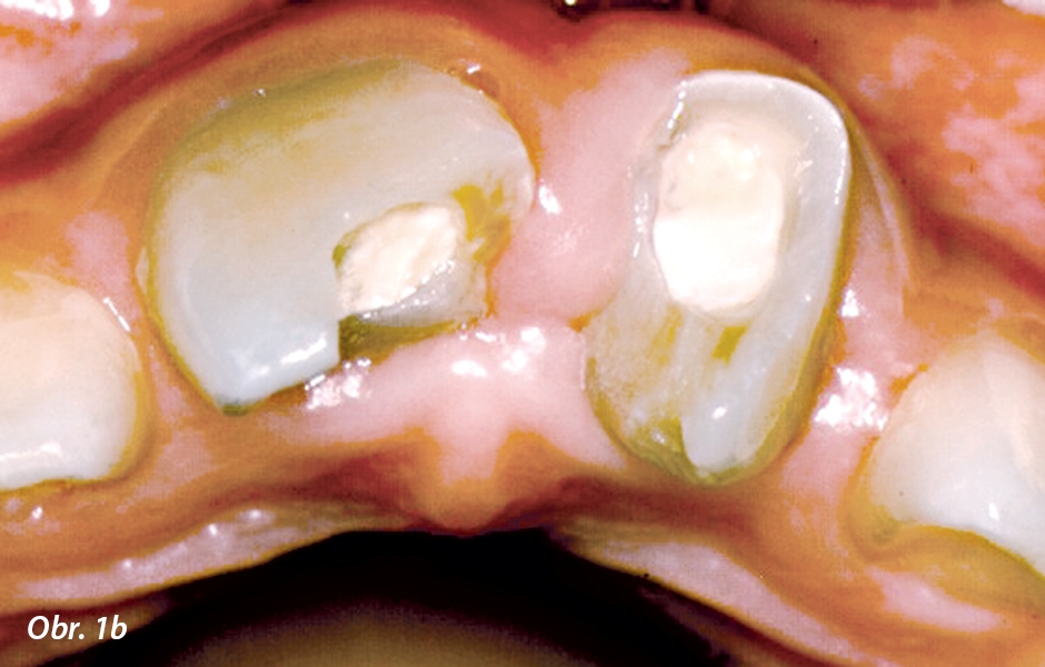 Fraktury v dentinu a sklovině korunek zubů 11 a 21 s intruzivním a rotačním posunem, související s předchozím akutním ošetřením. Pohled z incizální strany