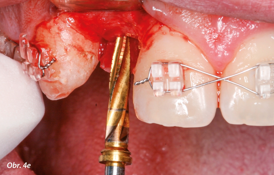 Sekvence vrtáků: e) zúžený implantologický vrták úzký až do 12 mm.