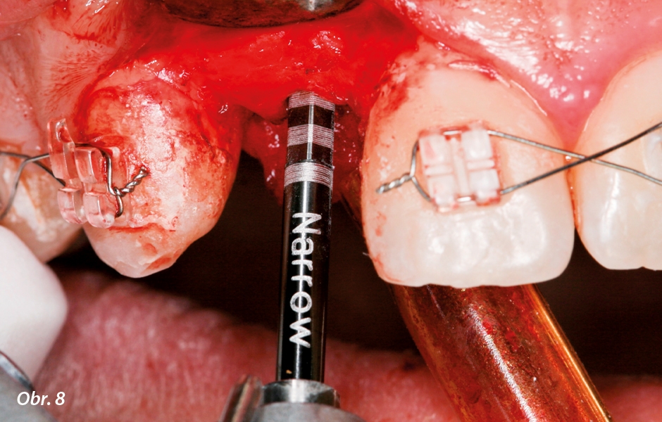 Úprava hloubky v místě implantátu pomocí ručního klíče – apikálně je prostor 3 mm mezi platformou implantátu a cementosklovinným spojením u sousedních zubů.