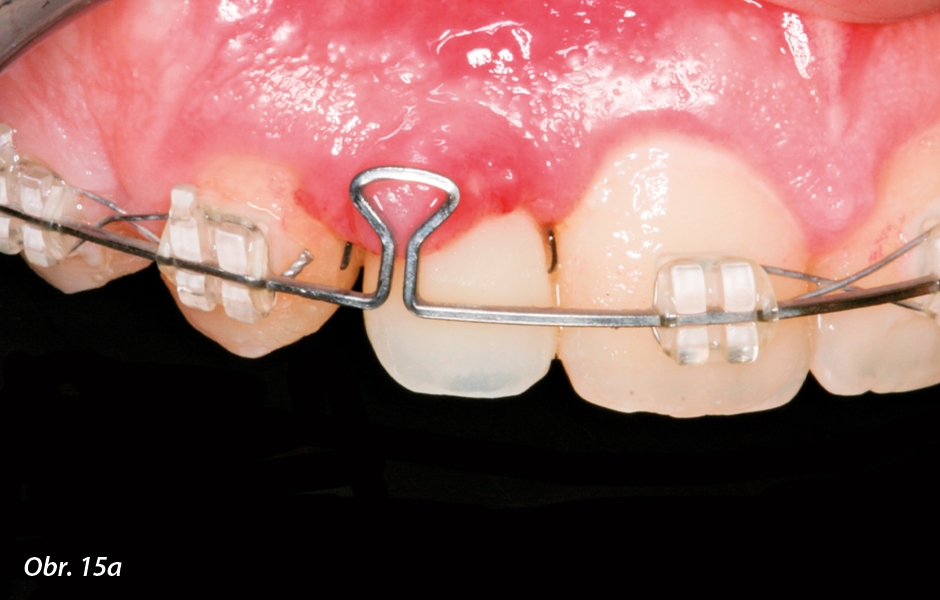 Ortodontické uzavření mezery: a) po 1 týdnu