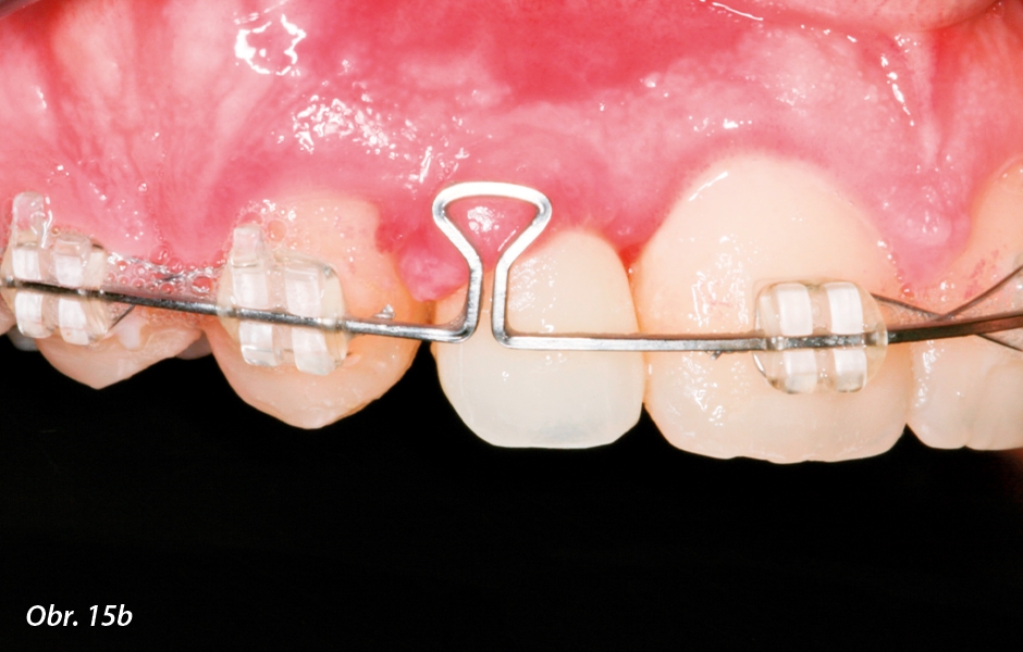 Ortodontické uzavření mezery: b) po 2 týdnech