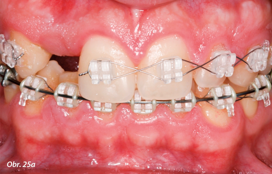 Pohledy na frontální zuby v okluzi: a) před ošetřením