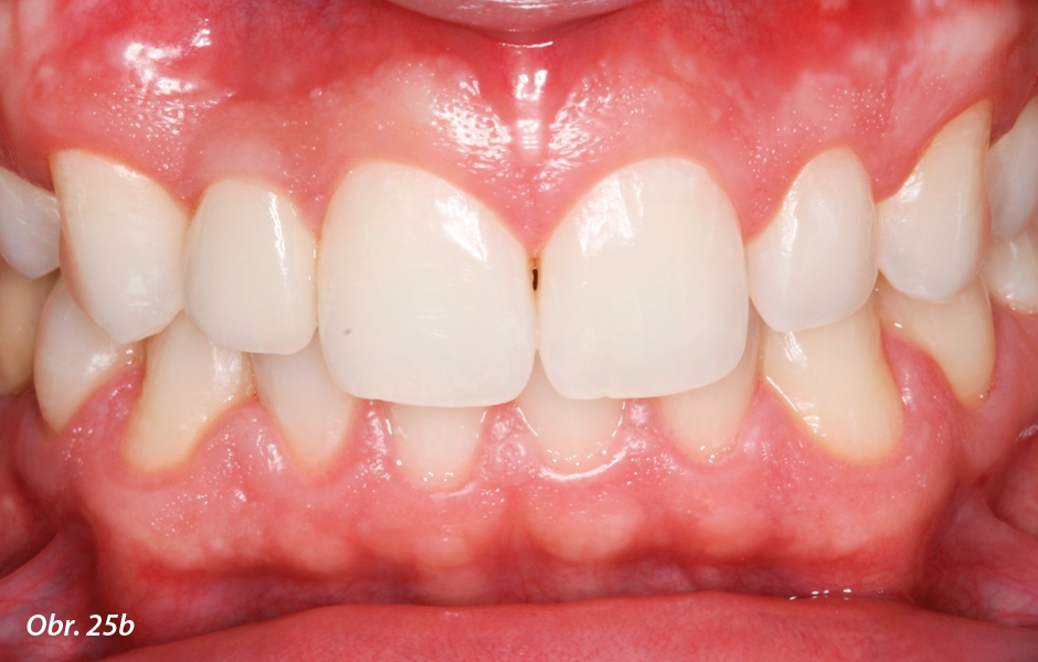 Pohledy na frontální zuby v okluzi: b) po ošetření