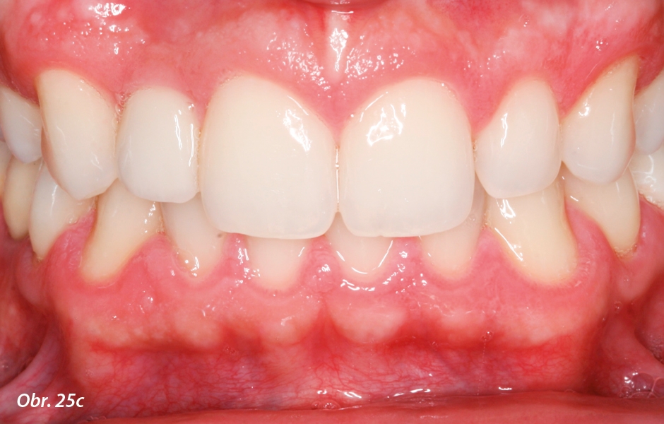 Pohledy na frontální zuby v okluzi: c) při kontrole po 3 letech
