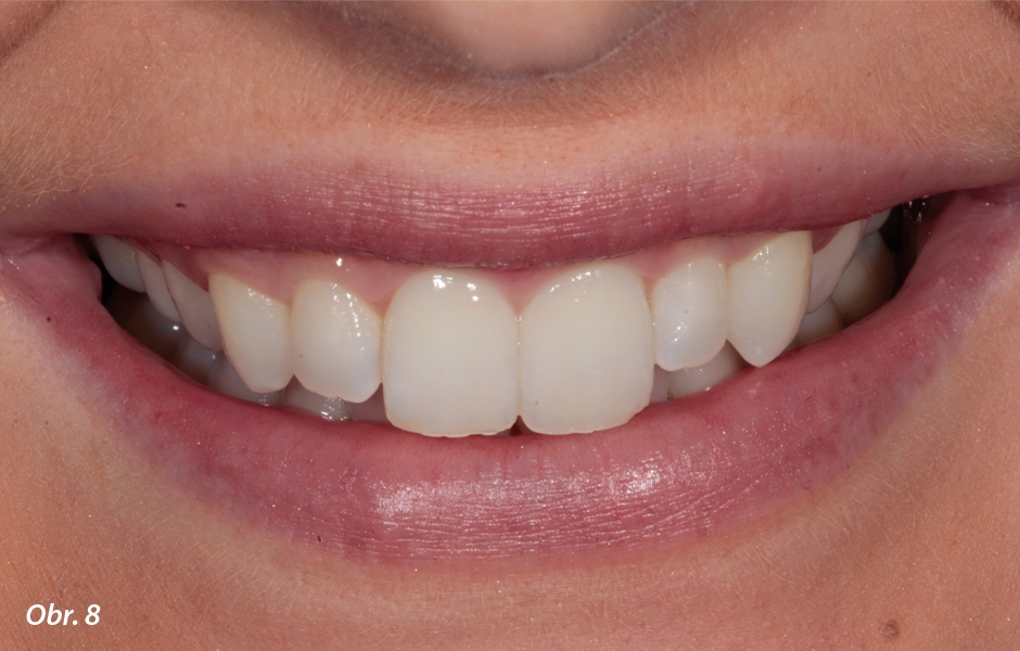 Poté, co si pacientka zvykla na srovnání a barvu svých zubů, mohla vidět dramatické zlepšení svého úsměvu.