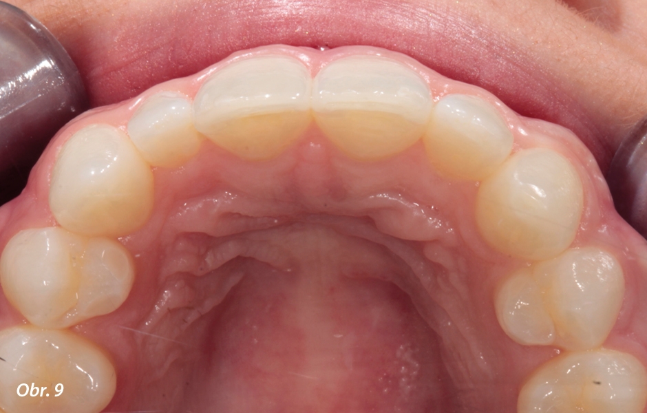 Poté, co si pacientka zvykla na srovnání a barvu svých zubů, mohla vidět dramatické zlepšení svého úsměvu.