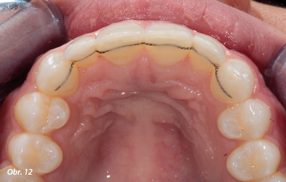Byl nabondován trvalý drátěný retainer za použití Venus Flow (Kulzer), aby se předešlo relapsu polohy zubů.