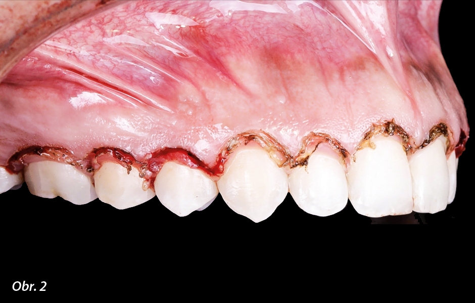 Iniciální řezy v 90 stupních k dlouhé ose zubu podél cementosklovinné hranice – pravá strana