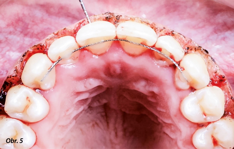 Zbylá gingiva po 90stupňových řezech z okluzálního pohledu