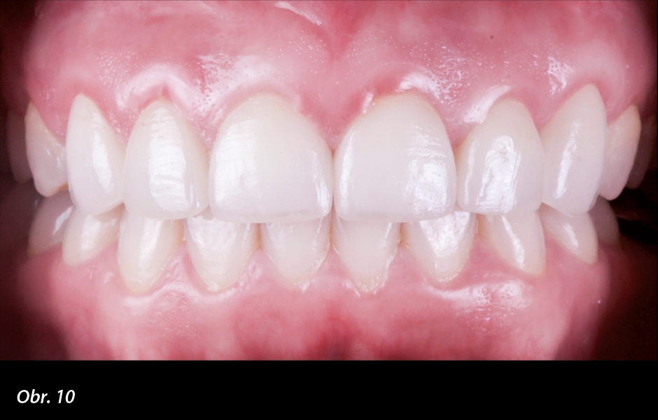 Případ 1: Kontrola po roce: perfektní barva, textura a konzistence gingivy – známky excelentního periodontálního zdraví