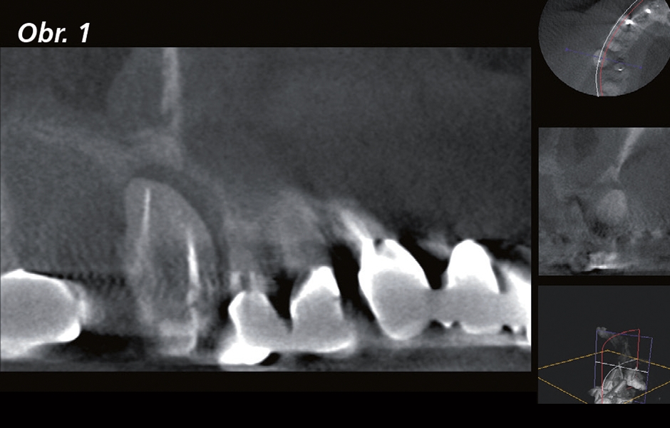 Pro lepší porozumění anatomii kořenových kanálků bylo provedeno intraorální rentgenologické a CBCT vyšetření