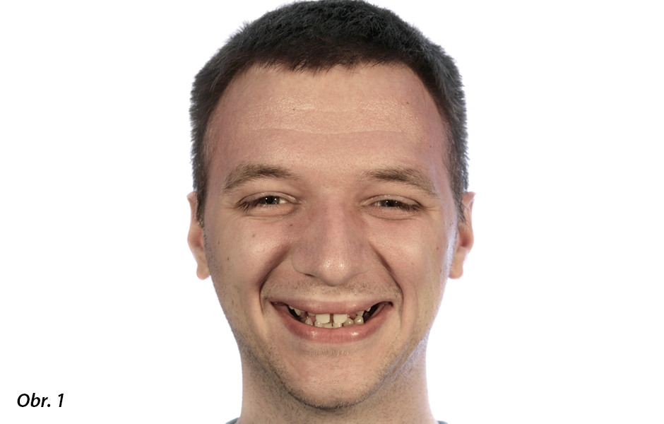 Pacient s hypodoncií: snímek iniciální situace. Celkem chybělo 14 zubů v horní a dolní čelisti.