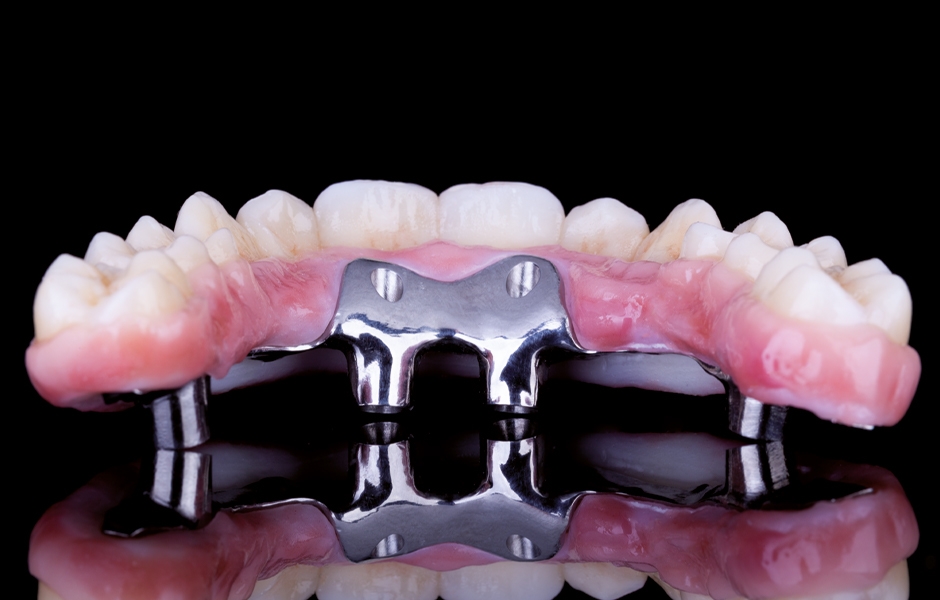 Rekonstrukce celého zubního oblouku v horní čelisti náhradou z polychromatického zirkonu Prettau® 2 Dispersive® lepenou na výztužný titanový třmen