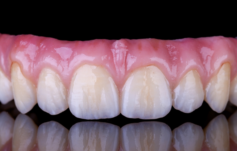 Výsledná náhrada vyrobená z polychromatického zirkonu Prettau® 2 Dispersive®, optimálně probarvená již z výrobního procesu hladkým přirozeným prostupem barev reprodukujícím barvy přirozeného zubu od dentinu po sklovinu (barevné schéma A1–D4).