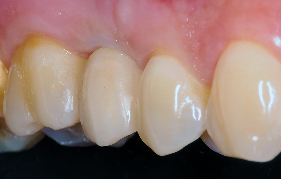 Dôležitosť objemu tvrdých a mäkkých tkanív, ako záruka dlhodobej funkcie zubných implantátov