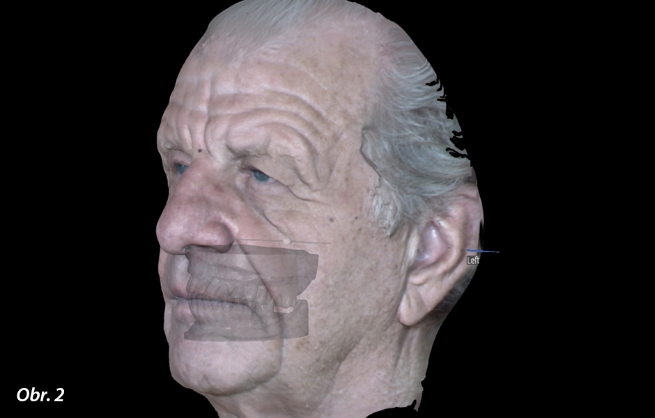 3D virtuální reprodukce pacienta vytvořená pomocí 3D obličejového skeneru Face Hunter a zobrazená v softwaru Zirkozahn.Scan se skeny modelů starých náhrad. Modely odhalily vysoký vertikální rozměr a dorzální pokles okluzní roviny v dolní čelisti.