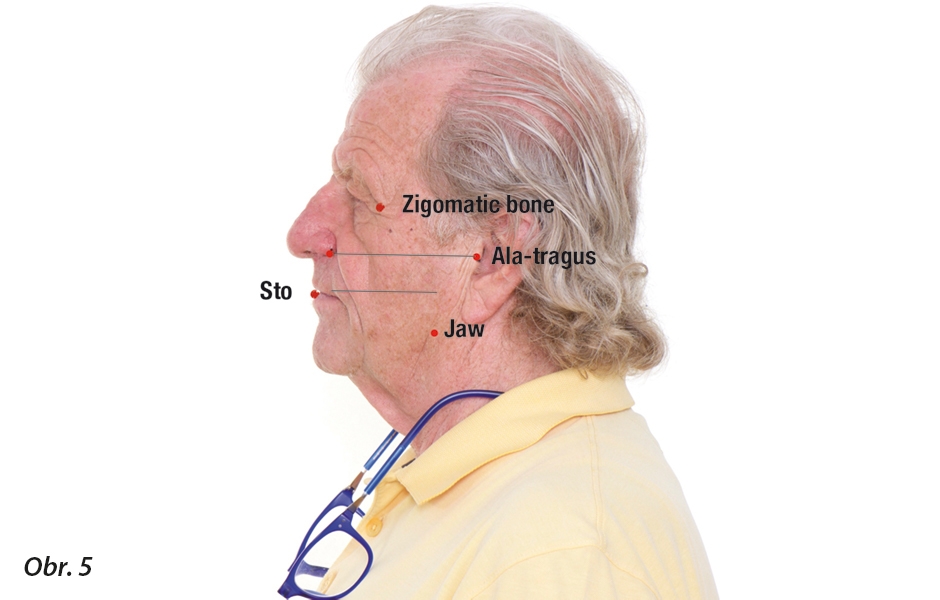 Rovina stomionu – paralelní k linii nasoaurikulární, úhlu dolní čelisti a zygomatické kosti