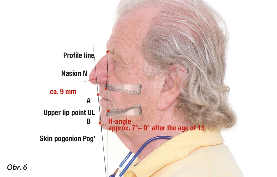 Holdawayova linie (linie procházející nejanteriornějším bodem brady, hranou horního rtu a protínající nos)
