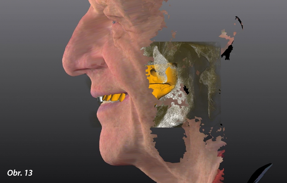 CBCT pacienta a STL data uzpůsobená 3D skenům obličeje v softwaru Zirkonzahn.Implant-Planner. Terapeutický prototyp byl navržen na základě diagnostické náhrady (bílé zuby).