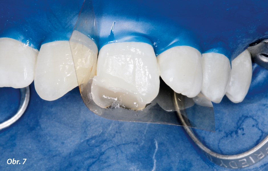 Byla umístěna průhledná plastová matrice a z Charisma Topaz OM bylo vymodelováno opakní dentinové jádro se strukturami mamelonů