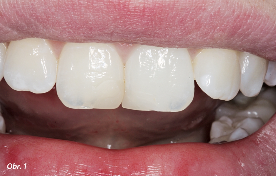 Stávající výplně v zubech 11 a 21, které byly zhotoveny před několika lety po úrazu při sportu