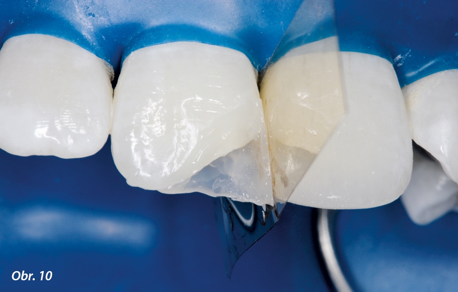 Stejný proces modelace se opakoval u zubu 11, počínaje u palatinální oblasti po aproximální a incizální oblast, opět za použití translucentního incizálního odstínu