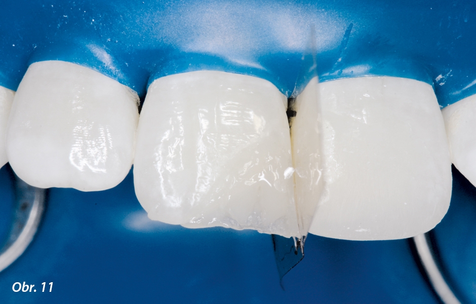 Bylo vymodelováno opakní dentinové jádro s incizálními strukturami mamelonů