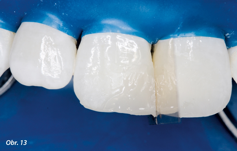 Stejně jako u zubu 21 byla incizní hrana zubu 11 vytvořena z translucentního incizálního materiálu