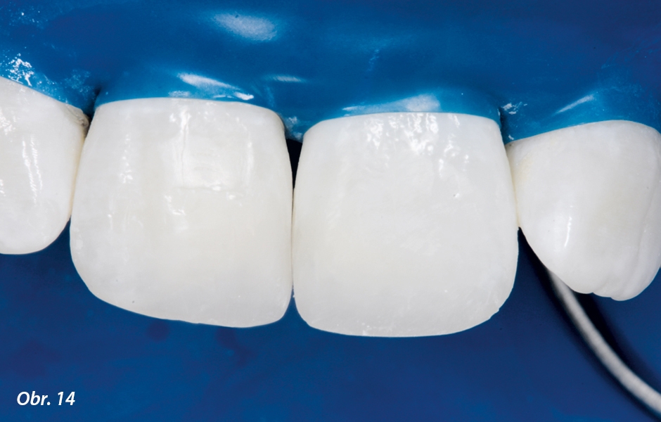 Meziální výplně kavit IV. třídy u zubů 11 a 21 z Charisma Topaz po hrubém dokončování