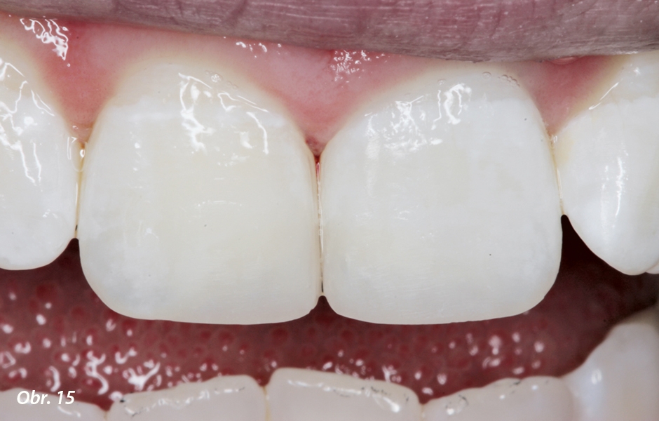 Odstín Charisma Topaz CL poskytuje incizním hranám translucentní vzhled, zatímco opakní dentinové jádro zabraňuje prosvítání dutiny ústní. Sklovinné povrchy byly vymodelovány z Charisma Topaz A2.