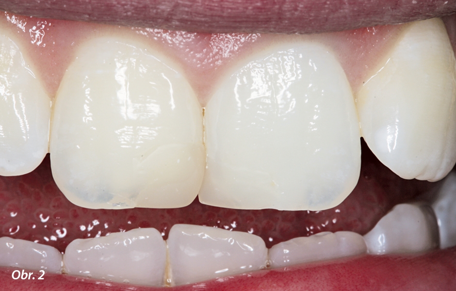 Snímek zřetelně odhaluje rozdíly v barvě a tvaru mezi výplněmi kavit IV. třídy a meziální částí zubů 11 a 21 a zbytkem zubů