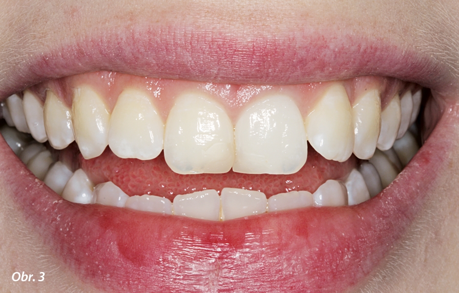 Pacientka byla nešťastná z toho, že barva a tvar zubů 11 a 21 jsou viditelně neestetické