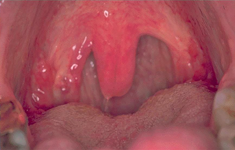 Obr. 4: Velká uvula (čípek).