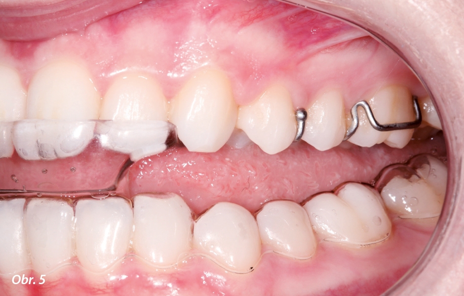 Kontakt pouze s dolními řezáky, žádný kontakt se špičáky, premoláry a moláry.