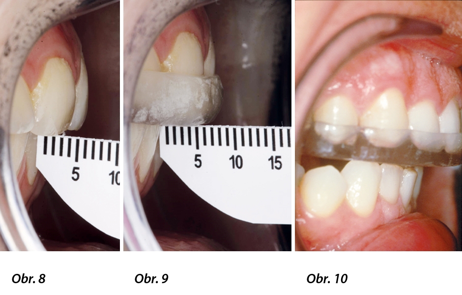 Obr. 8: Předkus 3 mm při centrální okluzi. Obr. 9: Aparát pro bruxismus, předkus 6 mm při distalizované dolní čelisti. Obr. 10: Noční chránič pro horní čelist – po plochém povrchu se dolní čelist posouvá dozadu.