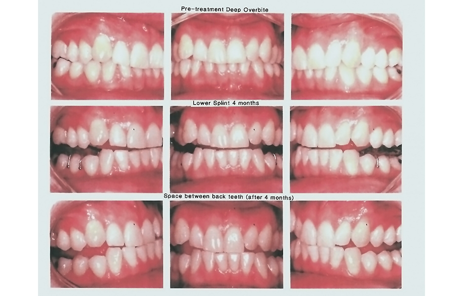 Obr. 10: Fotografické schéma, které je součástí informovaného souhlasu: - Před léčbou: hluboký překus. - Dolní dlaha na 4 měsíce. - Prostor mezi zadními zuby (po 4 měsících).