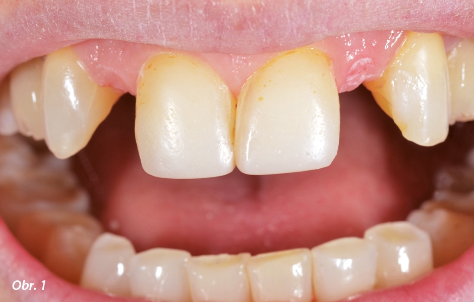 The Zirconia Resin Bonded Bridge (RBB)