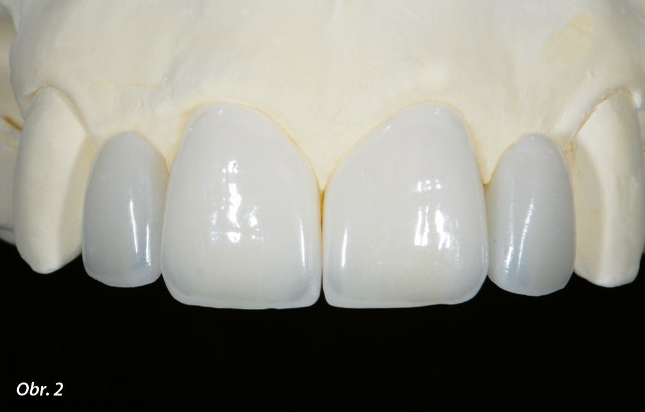 The Zirconia Resin Bonded Bridge (RBB)