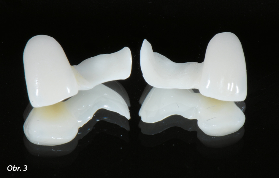 The Zirconia Resin Bonded Bridge (RBB)