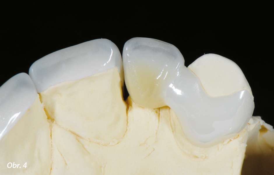 The Zirconia Resin Bonded Bridge (RBB)