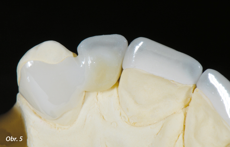 The Zirconia Resin Bonded Bridge (RBB)